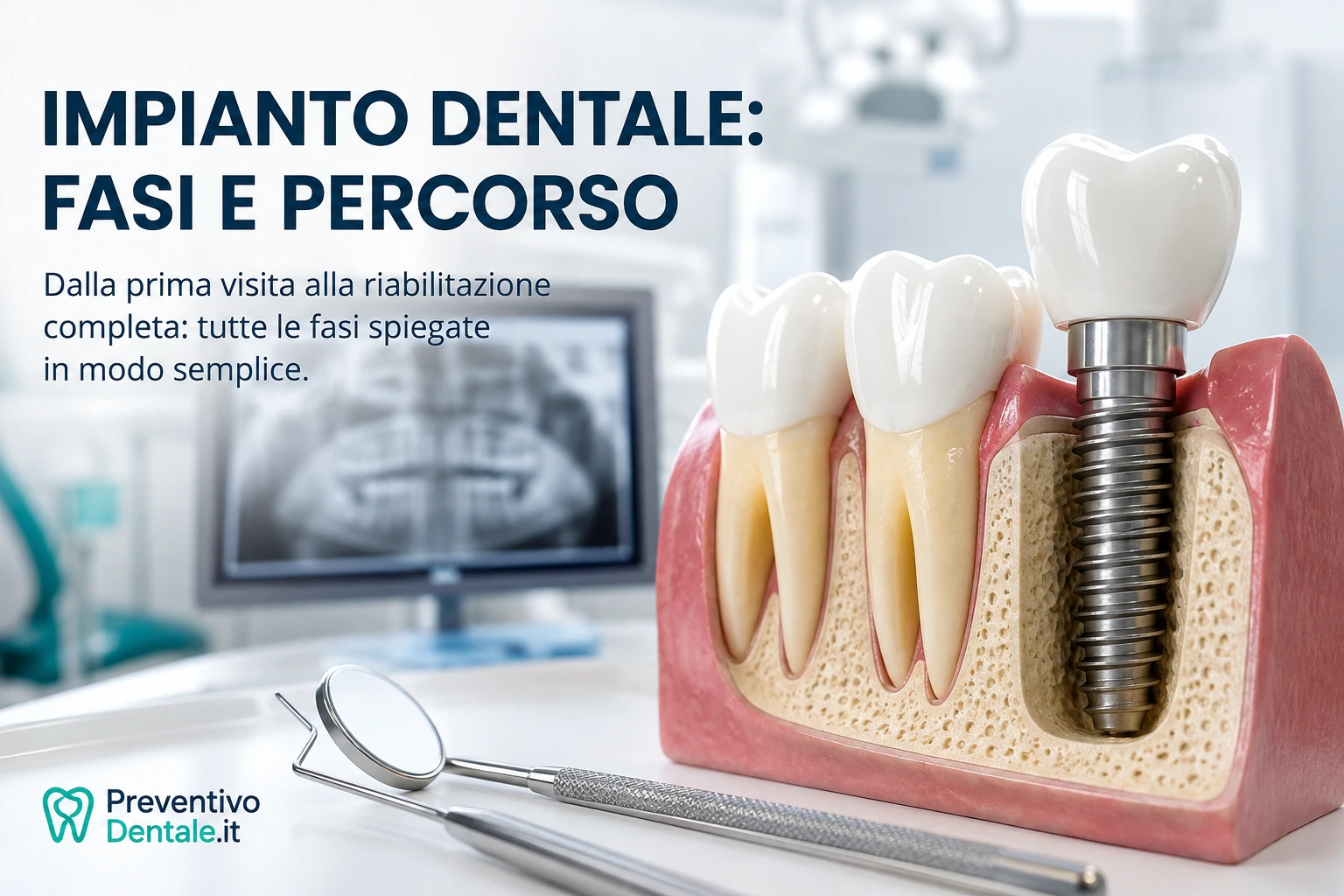 Impianto dentale: quali sono le fasi del percorso